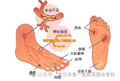 【石狮糖尿病下肢溃烂怎么办】糖尿病