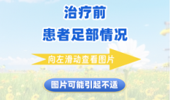 【石狮看糖尿病烂脚哪个医院好】血糖