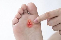 【石狮治糖尿病脚烂哪家医院好】糖尿