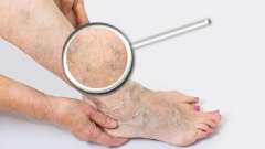 一个小伤口，一直不愈合还越烂越厉害