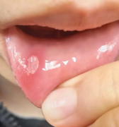 口腔溃疡：小疮口背后的大学问