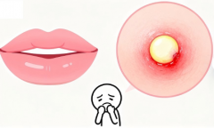 吃饭像 “受刑”？别忍！口腔溃疡的缓