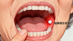 确诊口腔黏膜炎！拖延不治3个严重后果