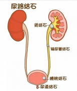小结石能自行排出？警惕这个认知误区