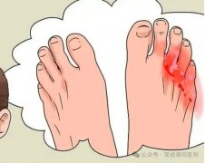 糖尿病足为何可怕？从麻木到溃疡，这