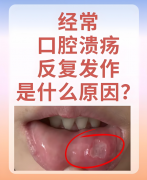 反复口腔溃疡，可能不是单纯的“上火