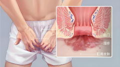 肛门瘙痒尴尬难耐？医生教你几招科学