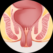 直肠脱垂，可防可控！医生教你日常预