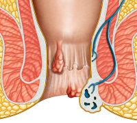 为什么痔疮突然变硬变疼？你可能得了