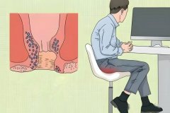 肛门外的肉球怎么判断是不是痔疮?