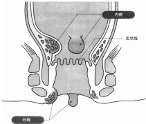 便血不痛，比痛的更危险？身体发出的
