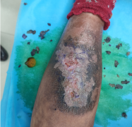 十年“老烂腿”患者重获新生，石狮现