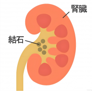 小小结石别硬扛，久拖可能诱发癌变！