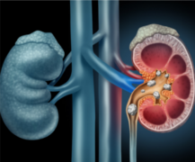 肾结石：别让“小石头”砸了你的健康