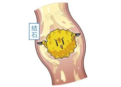 秋冬不想结石悄悄变大？早筛查是 “第