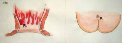 【石狮治疗痔疮的医院】有“痔”青年