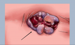 别把痔疮不当回事，嵌顿发作可致命！