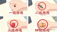 【别再忍了！】痔疮久拖不治，10大后果