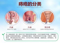 不同位置的痔疮，哪种最严重！？