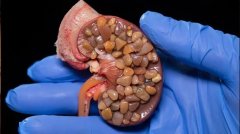 肾结石不痛就没事？忽视它的4大危害恐