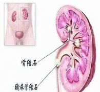 比牙痛更 “要命” 的痛！小小泌尿系结